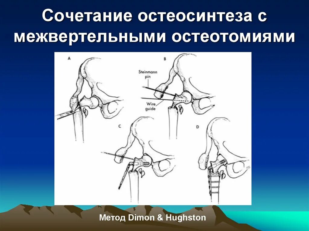 Остеотомия шейки бедра. Межвертельная остеотомия. Сочетанный остеосинтез. Осложнения остеосинтеза