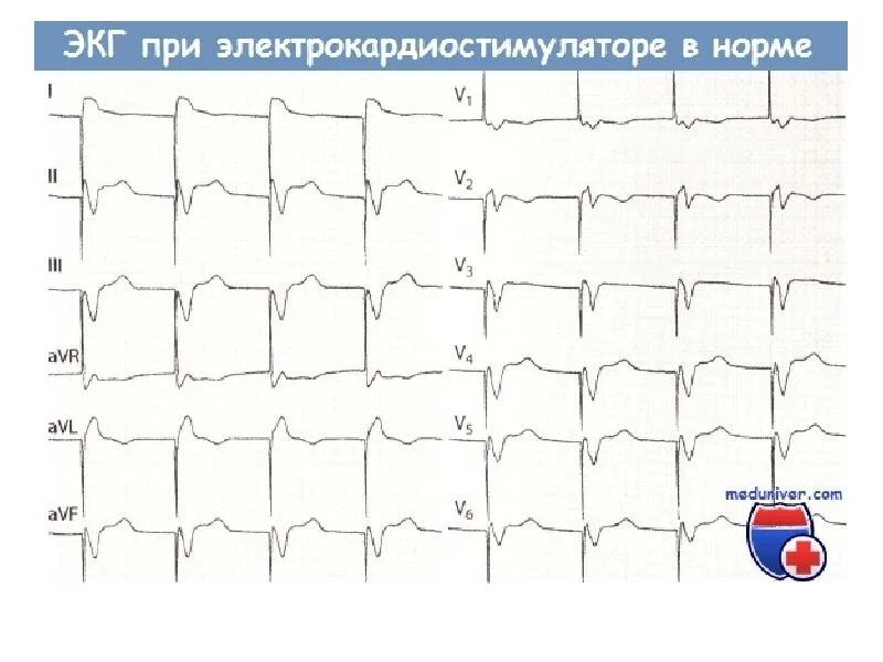 ЭКГ при кардиостимуляторе в режиме VVI. ЭКГ при электрокардиостимуляторе. Режим VVI кардиостимулятора что это на ЭКГ. Ритм при кардиостимуляторе описание ЭКГ.