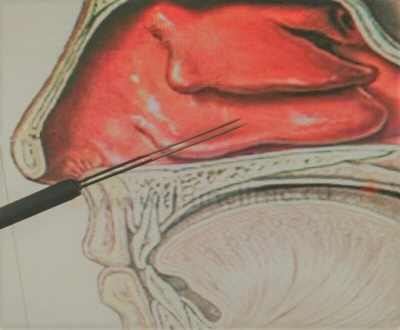 Вазотомия носовых раковин вазомоторный ринит. Вазомоторный ринит эндоскопия. Вазомоторный ринит операция. Вазомоторный ринит носовые раковины. Вазотомия носовых раковин операция