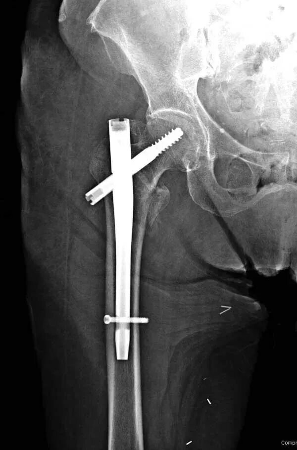 Сломана шейка бедра операция. Остеосинтез чрезвертельного перелома. Перелом бедра чрезвертельный перелом. Межвертельный перелом остеосинтез. Чрезвертельный перелом бедра операция остеосинтез.