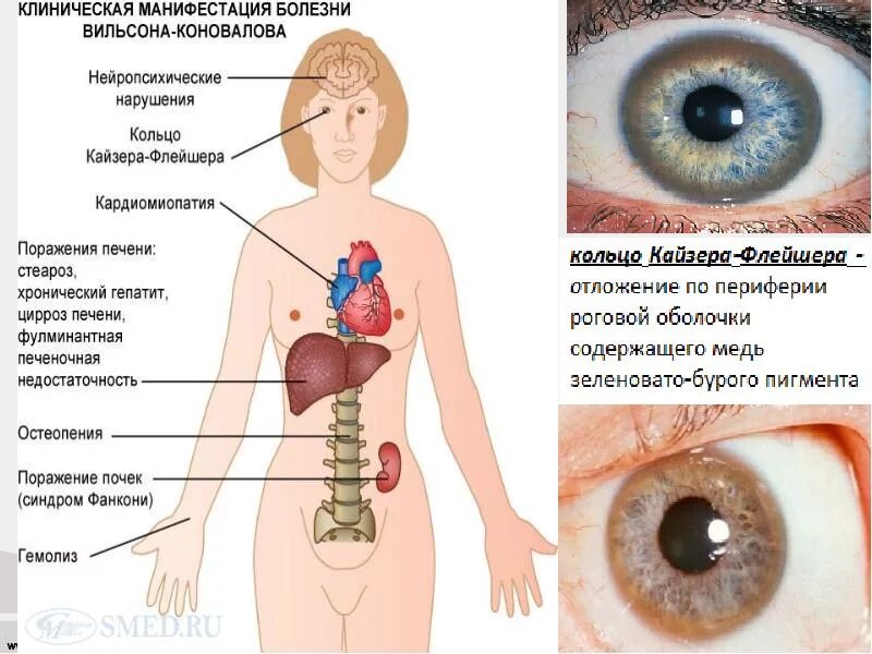 Гепатоцеребральная дистрофия болезнь Вильсона Коновалова. Болезнь Вильсона Коновалова клинические проявления. Фенотип Вильсона Коновалова. Болезнь Вильсона Коновалова абдоминальная форма. Синдром вильсона коновалова что это такое простыми