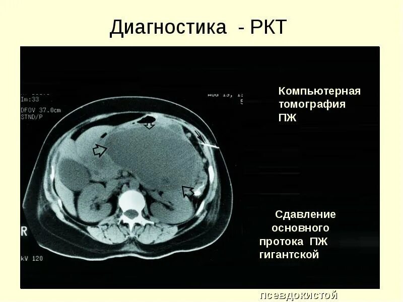 Что такое ркт. Опухоль поджелудочной железы РКТ. Кт заключение псевдокиста.