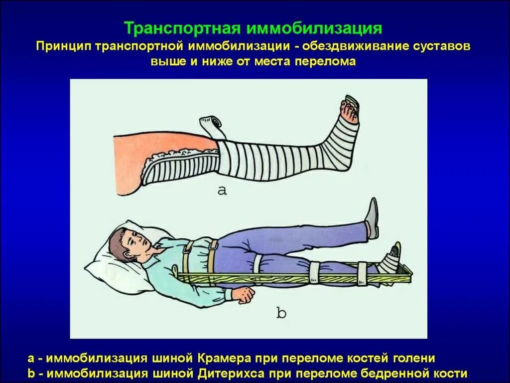 Кровотечение при открытом переломе голени. Шина Крамера и Дитерихса. Транспортная иммобилизация перелома голени шиной Дитерихса. Перелом бедра иммобилизация шинами Крамера. Шина Крамера перелом костей голени.