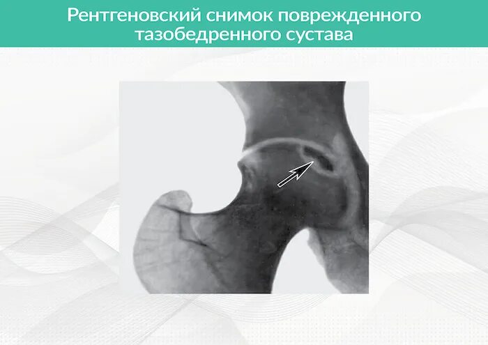 Асептический некроз головки шейки бедра. Импрессионный перелом тазобедренного сустава. Боли при некрозе тазобедренного сустава. Асептический некроз головки тазобедренного сустава рентген описание. Асептический некроз головки бедренной мкб.