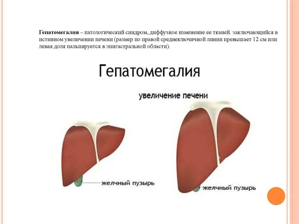 Изменения размера печени. Увеличение размеров печени. Размеры увеличенной печени.