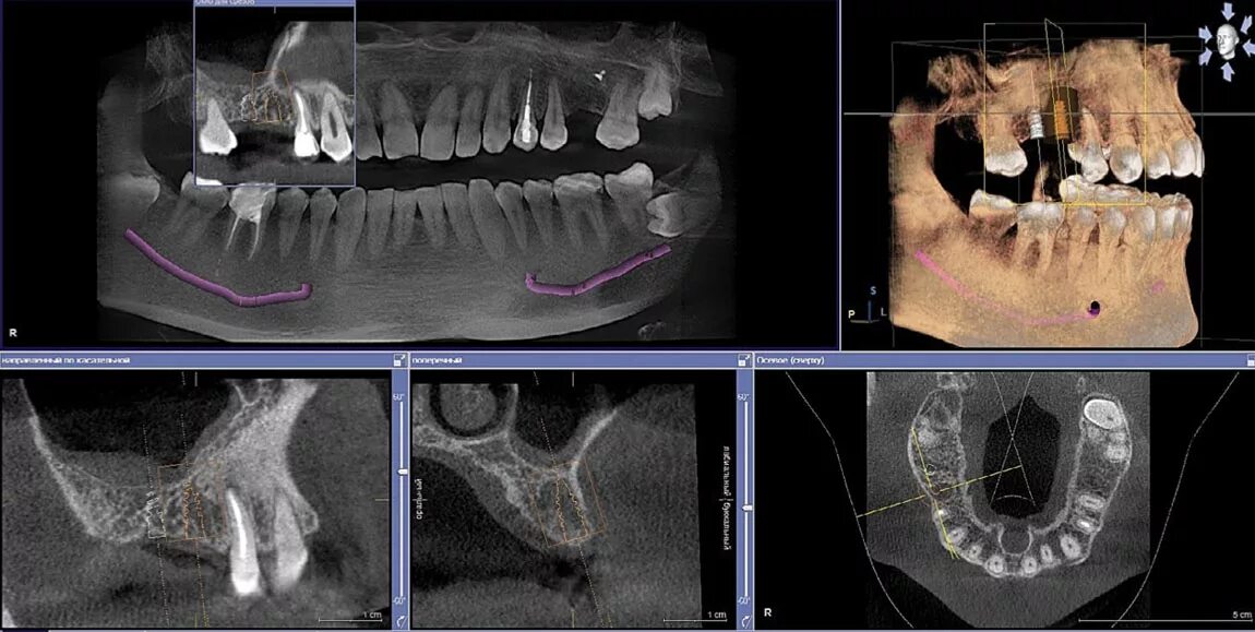 Можно ли с зубным имплантом делать мрт. Кт 3д зубочелюстной системы.