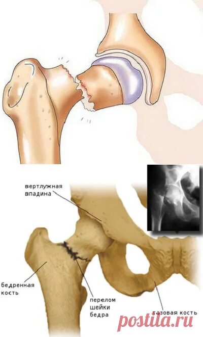 Вертлужная впадина бедра. Краевой перелом вертлужной впадины. Тазобедренный перелом шейки бедра. Несросшийся перелом шейки бедра. Симптомы шейка бедра у женщины