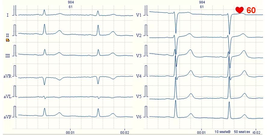 Глж на экг что это значит. Гипертрофия правого желудочка ЭКГ индекс. ЭКГ гипертрофия миокарда левого желудочка индекс Соколова Лайона. Индексы гипертрофии левого желудочка на ЭКГ. Соколова Лайона ЭКГ.