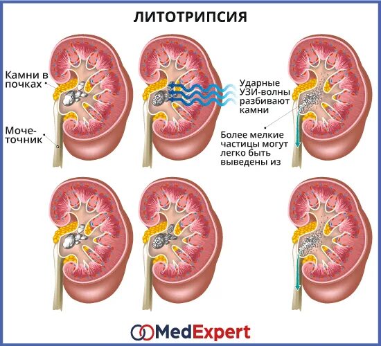 Ультразвуковое дробление камней. Ультразвуковое дробление камней. Таблетки при камнях в почках. Препараты растворяющие камни в почках. Препарат который дробит камни в почках.