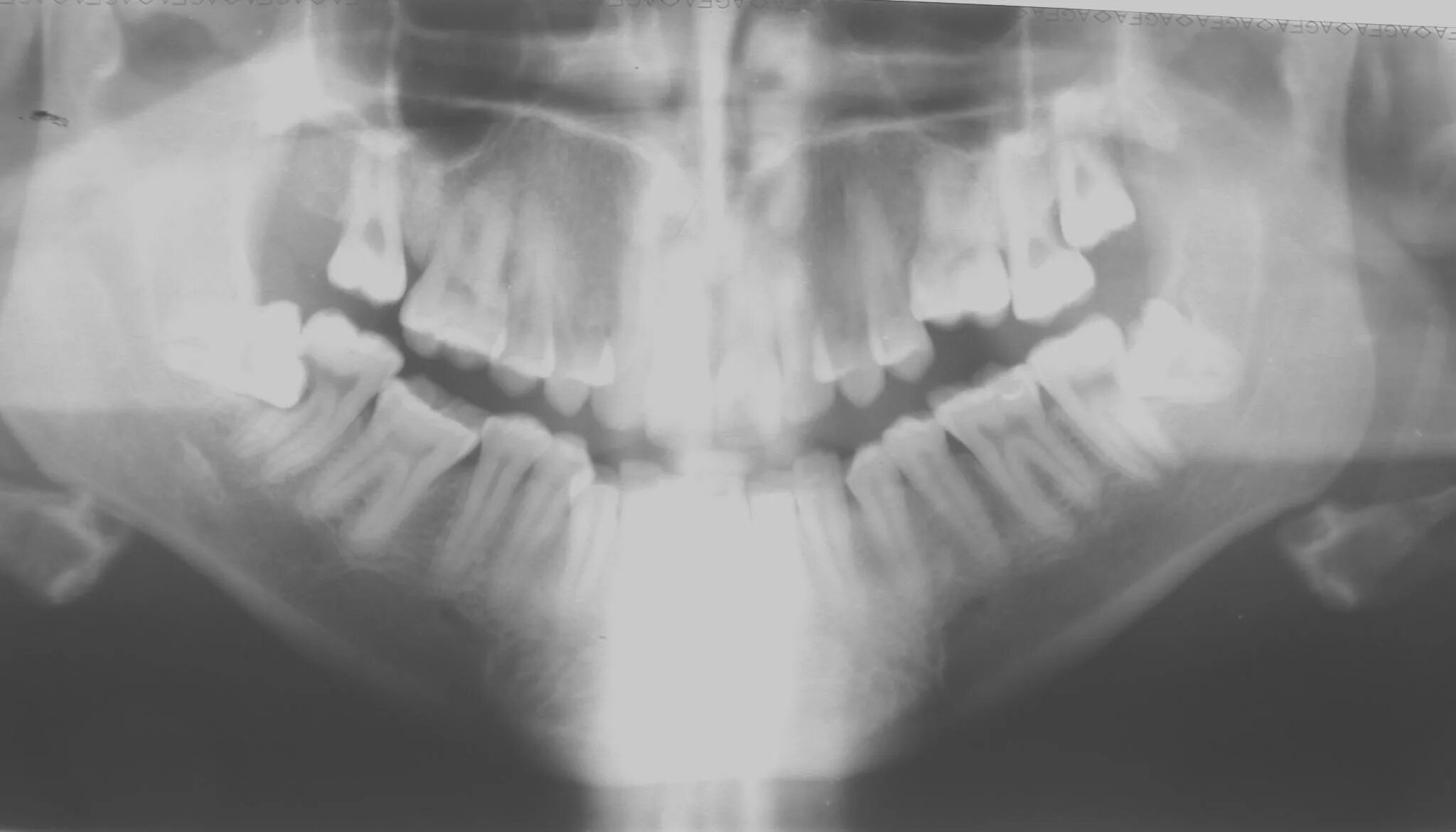 Неправильное положение зуба. Мкб-10 международная классификация болезней зубов. Ретинированный зуб мудрости рентген. Мкб 10 стоматология коды. Затруднённое прорезывание зубов мудрости.