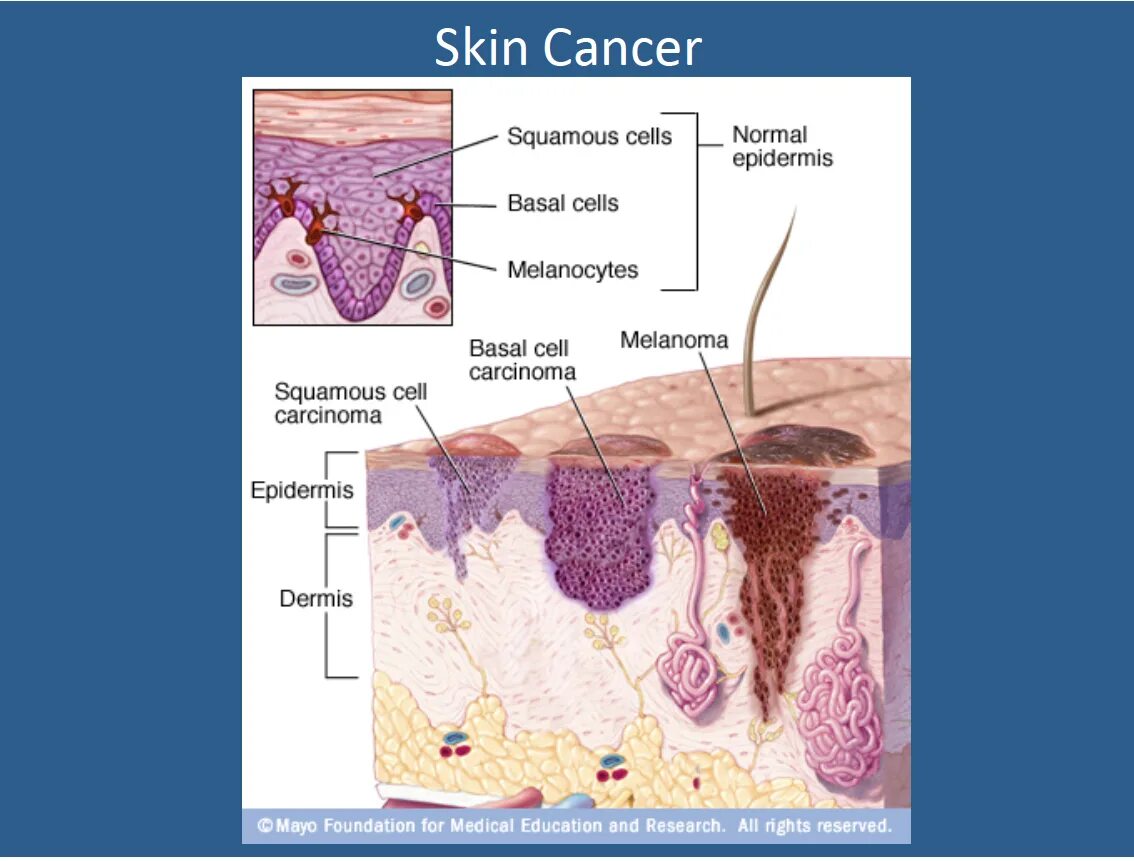 Плоскоклеточный рак кожи лица как выглядит Cutaneous squamous-cell carcinoma Wikipedia