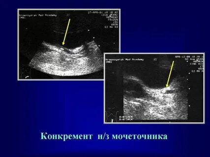 Исследование конкремента