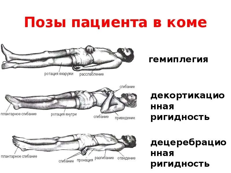 Положение больного на столе. Положение больного при коме при транспортировке. Положение пациента на операционном столе. Пациент на операционном столе. Транспортировка пациента в коме.