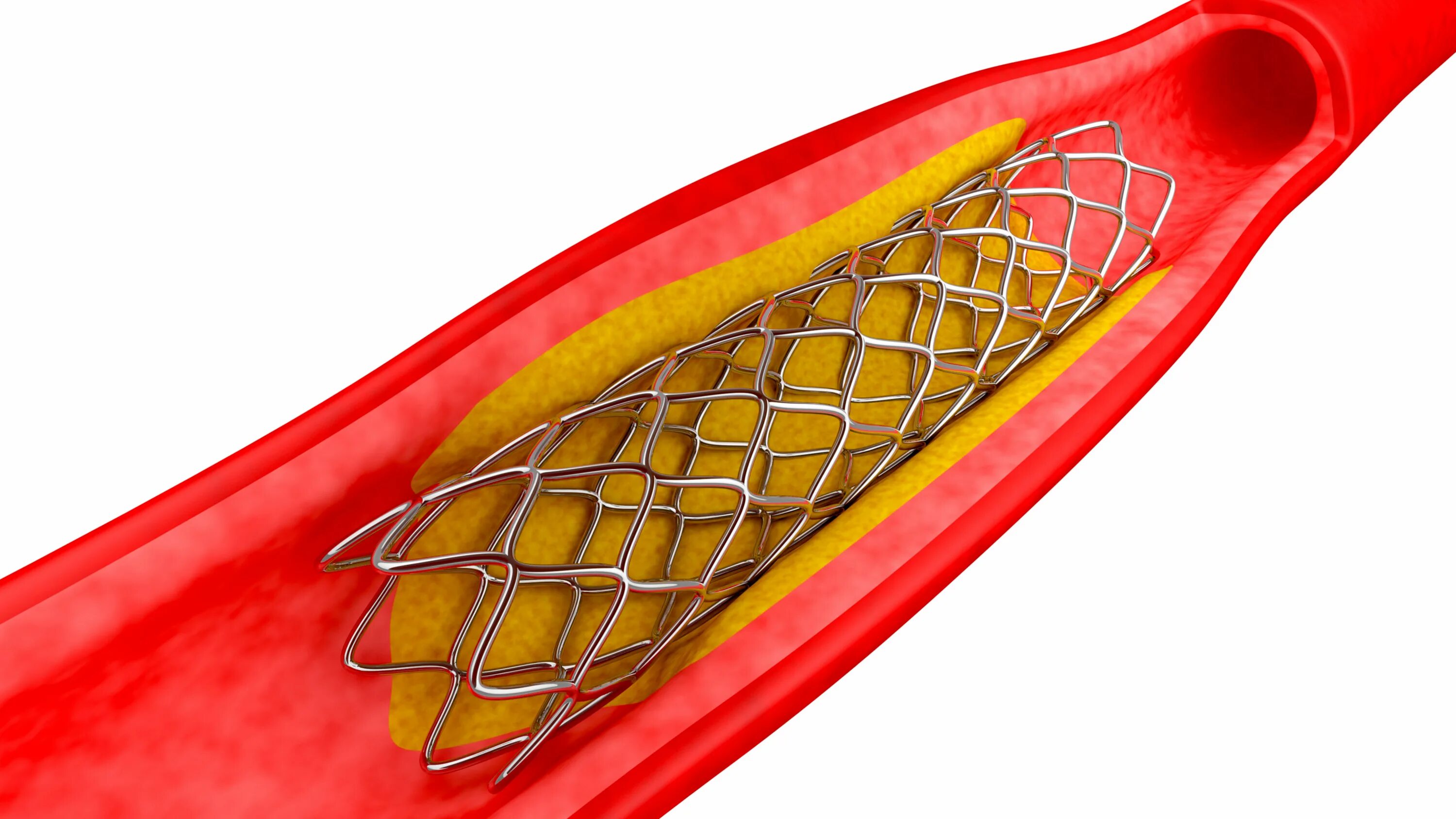 Стент фото. Металлический стент (bare Metal Stent. Стент Калипсо. Стентирование коронарных артерий.