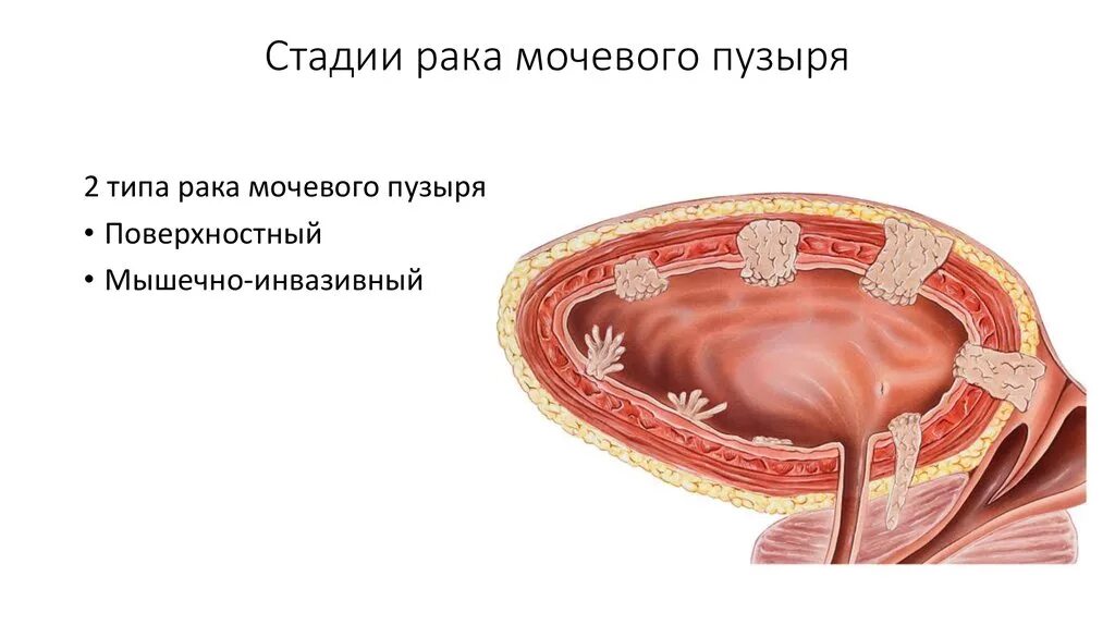 Стадии опухоли мочевого пузыря. ЗНО мочевого пузыря стадии. Размер опухоли мочевого пузыря по стадиям. Инвазивная стадия опухоли. Рак мочевого отзывы