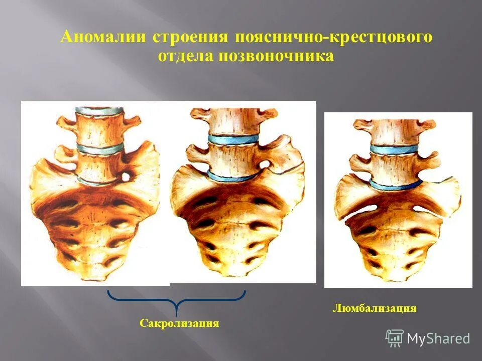 Понятие аномалии в анатомии. Аномалия строения. Эмалевые капли гиперплазия. Аномалия строения. Варианты и аномалии костей мозгового черепа.