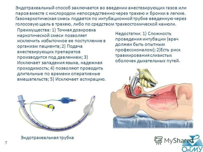 Комбинированный эндотрахеальный