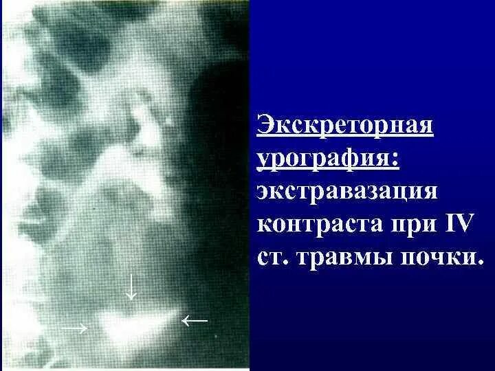 Что такое экстравазация. Экскреторная урография при повреждении почки. антеградная пиелоуретерография. экстравазация контраста.