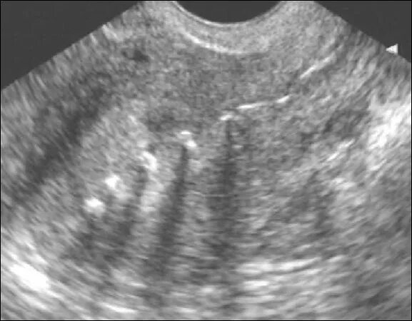 Гиперплазия полости матки. Гиперэхогенность эндометрия. Гиперплазия эндометрия на УЗИ. Синехии эндометрия на УЗИ. Децидуальный эндометрит что это.