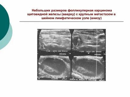 Щитовидная железа метастазы