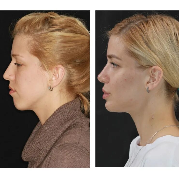 Дистальный прикус до и после. Ортогнатическая операция открытый прикус. Глубокий прикус лицо в профиль. Короткая нижняя челюсть. Глубокий прикус до и после.
