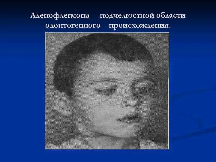 Абсцесс челюстного пространства. Абсцесс челюстного пространства