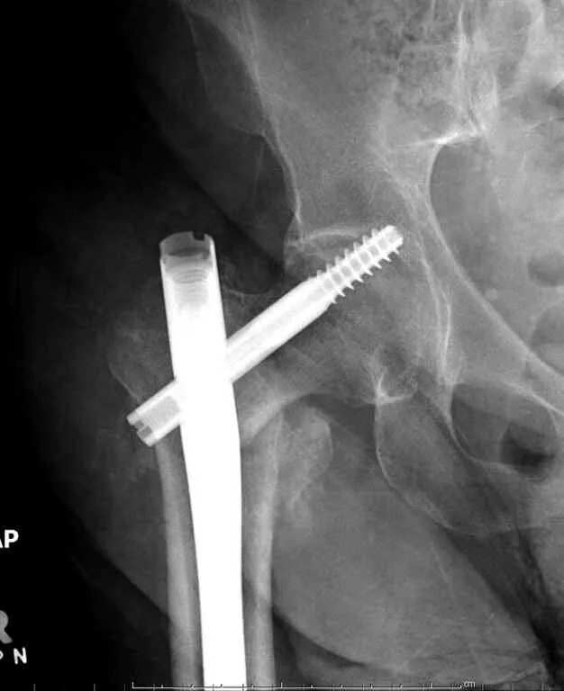 ложный сустав шейки бедренной кости. сросшийся перелом шейки бедра.