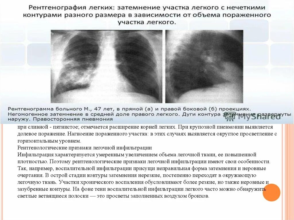 Округлое затемнение. Негомогенное затемнение легочной ткани. Затемнение доли легкого. Участок затемнения в легочной ткани.