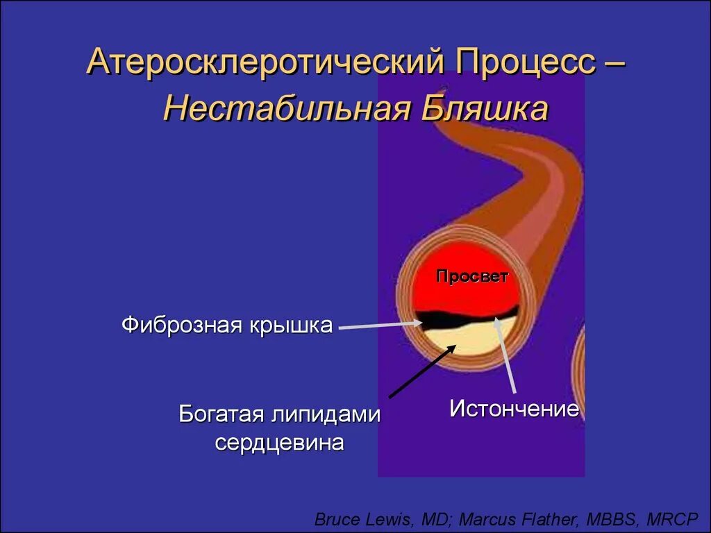 Что такое атеросклеротические бляшки