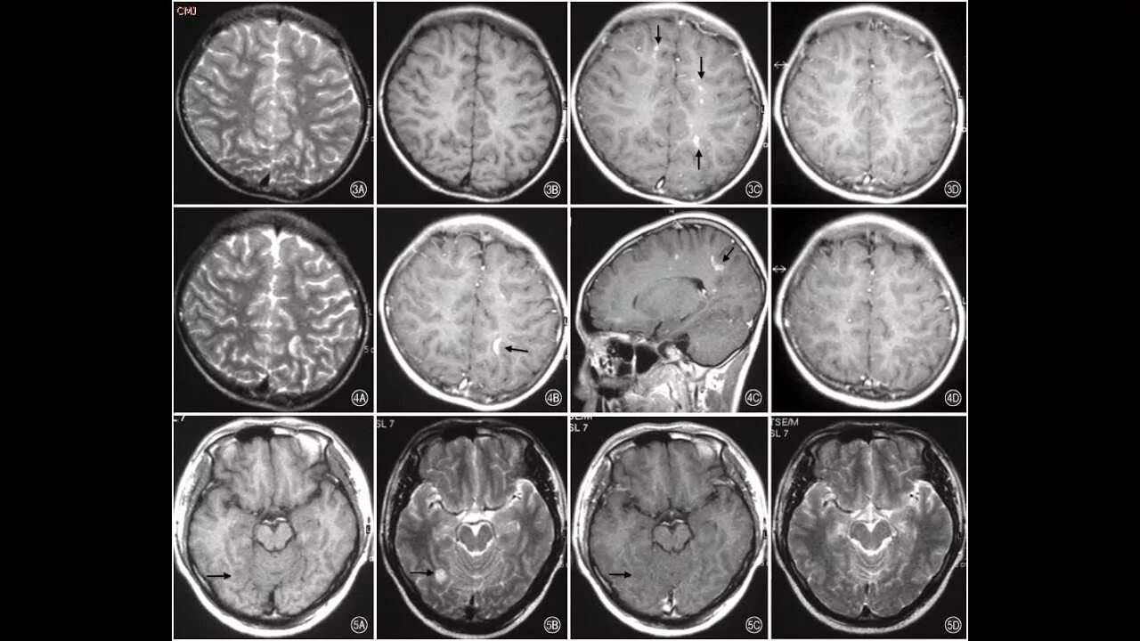 Поражение головного мозга диагноз. Энцефалит и менингоэнцефалит. Отогенный менингоэнцефалит. Менингит энцефалит и менингоэнцефалит. Менингит/менингоэнцефалит мрт.