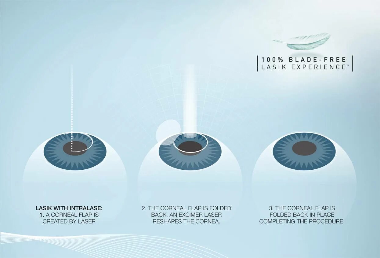 Коррекция зрения методом смайл. Лазерная коррекция зрения ласик. Лазерная коррекция зрения Фемто ласик. Лазерная коррекция зрения методом Femto-LASIK. Фемто ласик этапы.