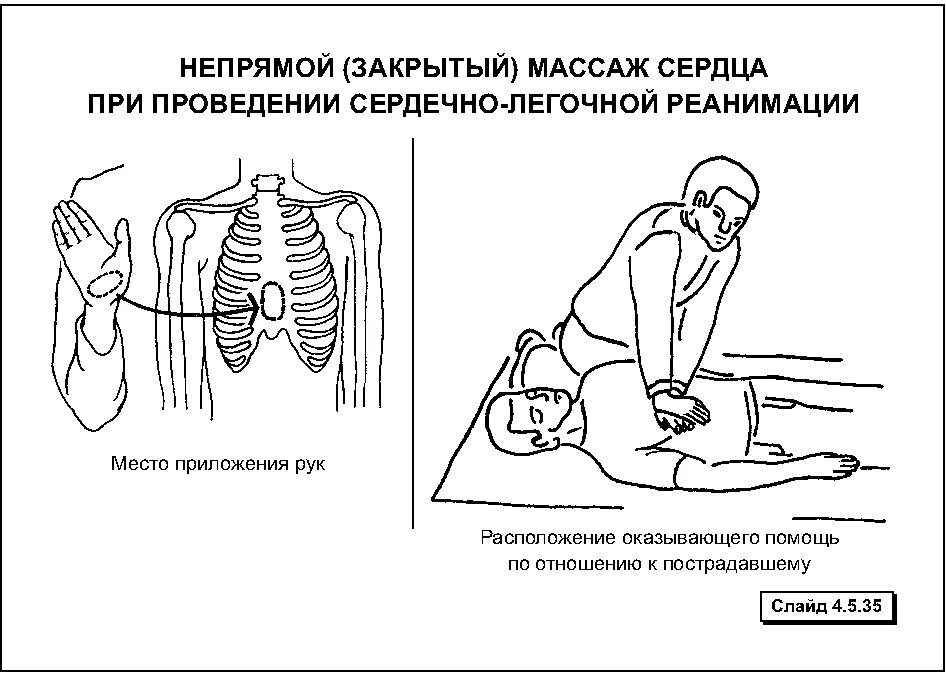 Руки в замок при сердечно легочной реанимации. Проведения сердечно-легочной реанимации непрямой массаж сердца. Положение рук при проведении сердечно легочной реанимации. Точка приложения рук при проведении непрямого массажа сердца. Ердечно-легочная реанимация (СЛР).