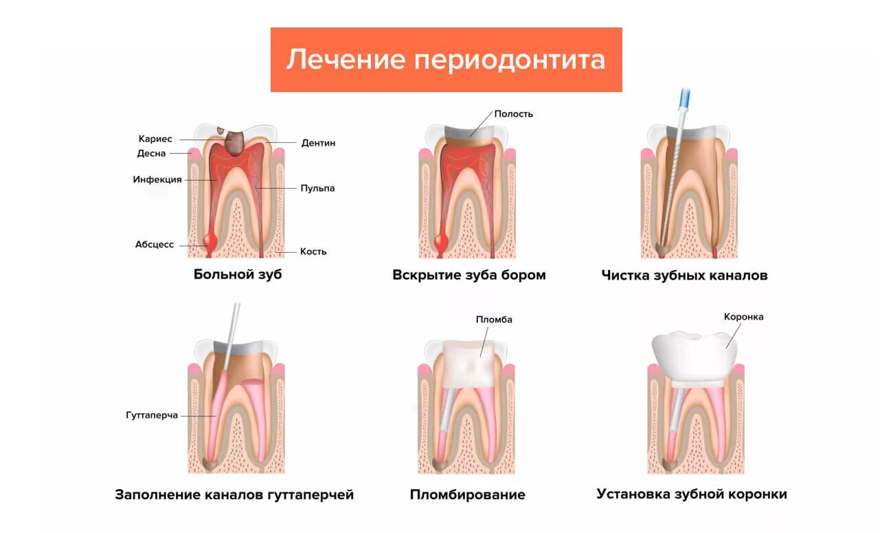 Хронический периодонтит пульпит. Хронический фиброзный периодонтит схема. Схема этапы лечения воспаления корня зуба. Хронический периодонтит 2.5 зуба.