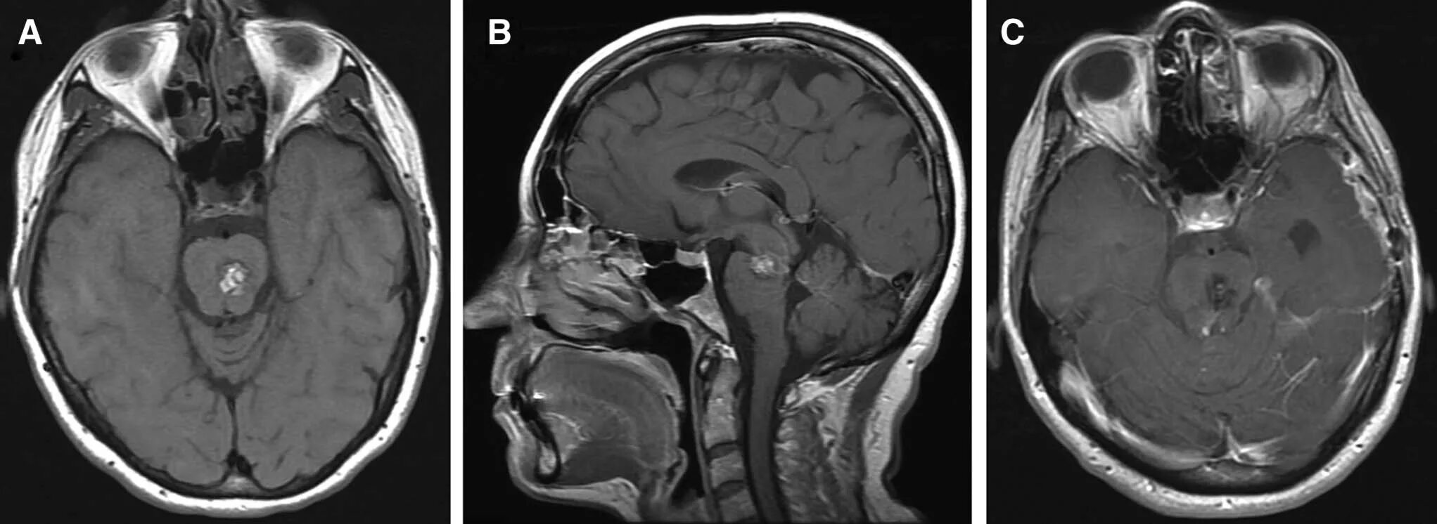 венозная ангиома мкб 10