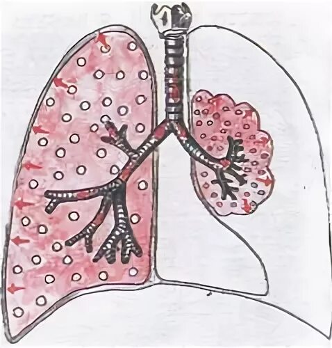 Спадение бронха