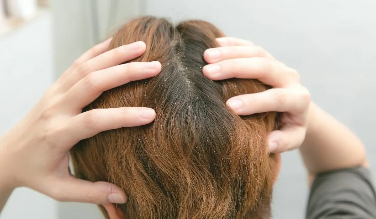 Жирные волосы. Жирные волосы фото. Очень жирные волосы. Очень жирнеют волосы. Очень сальные волосы.