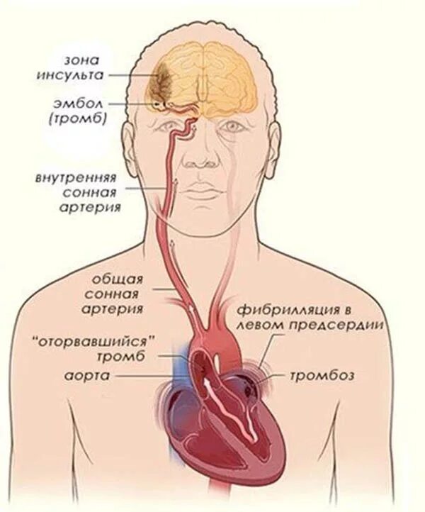 Сердечный тромб. Оторвался тромб в сердце.
