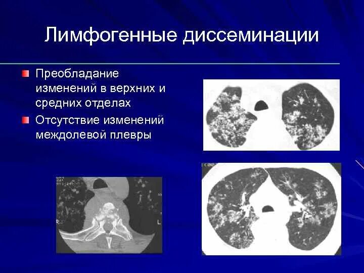 Лимфогенный туберкулез. Диссеминированный туберкулез на кт. Диссеминированый туберкулёз на кт. Лимфогенно диссеминированный туберкулез кт. Лимфогенная диссеминация кт.