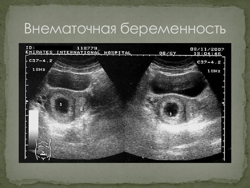 Внематочная беременность. Внематочная беременность на УЗИ. Гетеротопической беременности. Трубная беременность УЗИ.