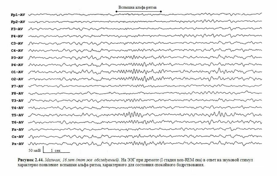 Альфа ритм ЭЭГ. ЭЭГ графики. Бета ритм ЭЭГ. Электроды ЭЭГ.