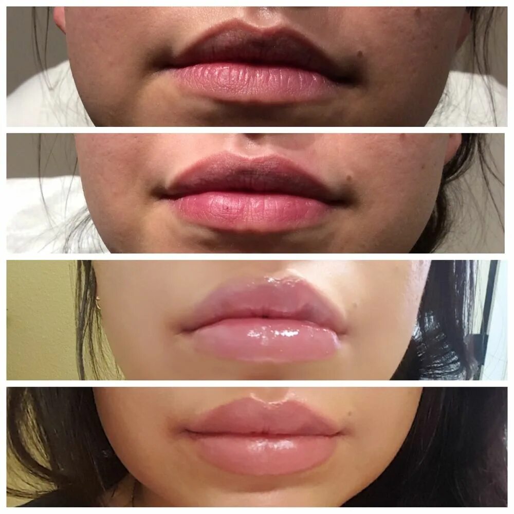 Восстановление губ после. Ювидерм 3 или Lip. Улыбка моны Лизы губы гиалуроновой кислотой. Коррекция губ гиалуроновой кислотой.