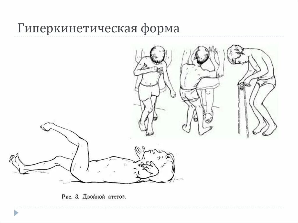 Гиперкинетическая форма дцп. Гиперкинетическая форма ДЦП поражение. Формы ДЦП Дискинетическая форма. ДЦП дети Дискинетическая форма.