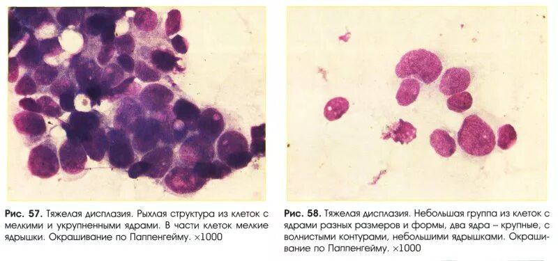 дисплазия плоского эпителия тяжелой степени. дисплазия гистопрепарат. дисплазия плоского эпителия 2-3 степени. дисплазия плоского эпителия тяжелой степени. дисплазия плоского эпителия тяжелой степени.