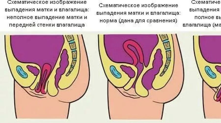 Опущение малого таза у женщин