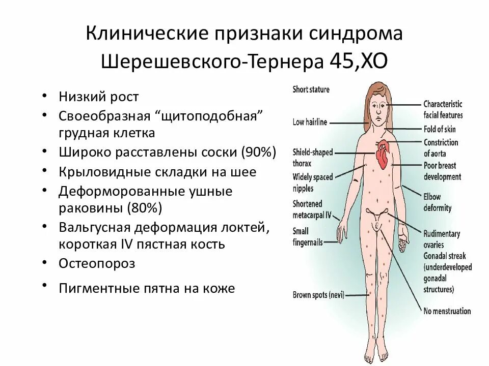 Синдром Шерешевского Тернера симптомы. Синдром Шерешевского Тернера клинические проявления. Синдром Шерешевского Тернера проявления. Клинические проявления синдрома Тернера.