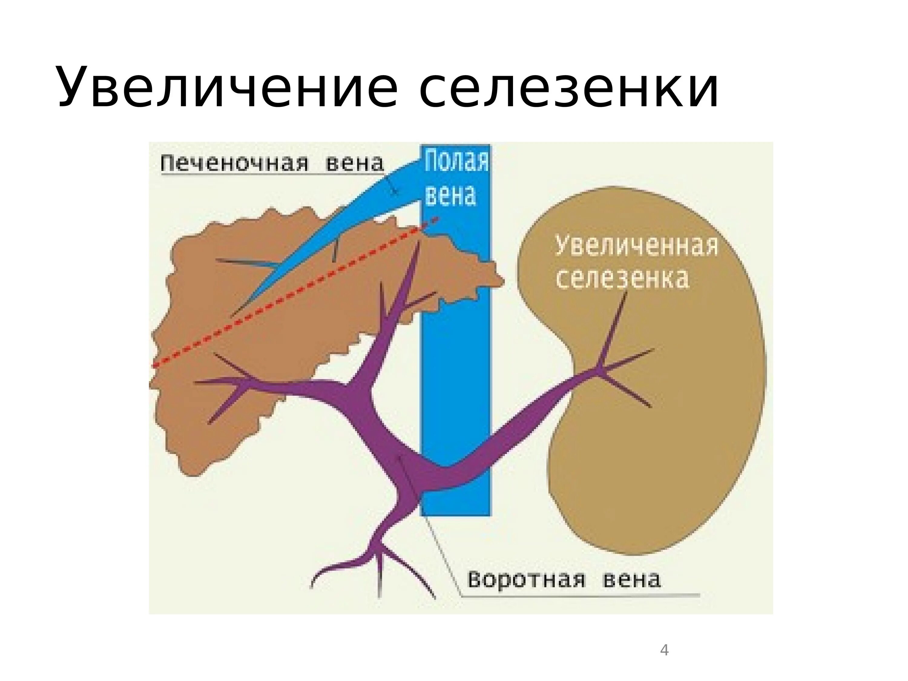 Внутрипеченочная портальная гипертензия. Предпеченочная портальная гипертензия. Спленомегалия при портальной гипертензии. Портальная гипертензия внутрипеченочный блок. Расширение селезеночной вены