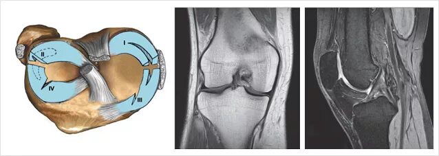 Мрт коленного сустава разрыв мениска. Разрыв заднего рога медиального мениска мрт. Паракапсулярная киста коленного сустава. Снимок мрт коленного сустава с разрывом мениска. Повреждение переднего рога