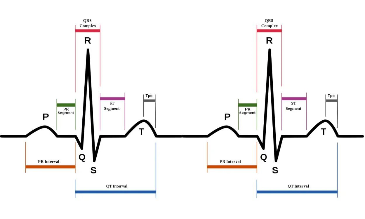 Re load interval 500 re upload interval. Комплекс QRS на ЭКГ. Комплекс QRS 0.05. Расширение комплекса QRS. Ширина QRS.