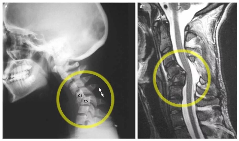 Стеноз инвалидность. Подвывих Атланта рентген. Гипермобильность позвонков шейного отдела рентген. Смещение позвонков с4-с7. Нестабильность с 3-4 -5.