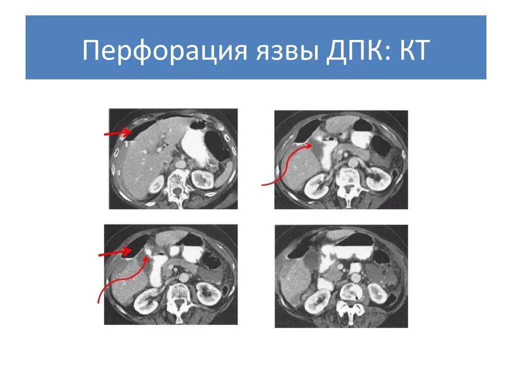 Язва желудка кт. Кт при перфоративной язве. кт при перфорации язвы желудка. перфорация язвы желудка на кт.